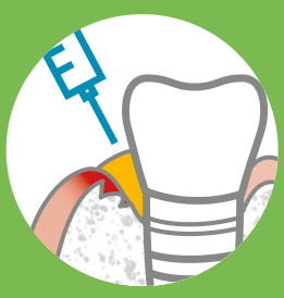 Perimplantite
